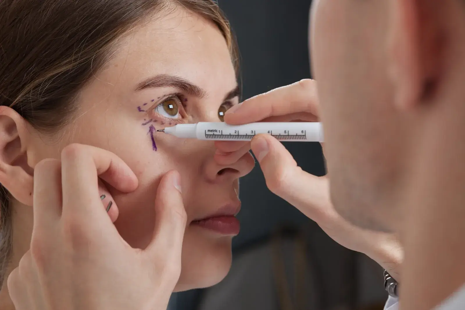 Blefaroplastia — Perfect by Dr. Orsini, Caracas