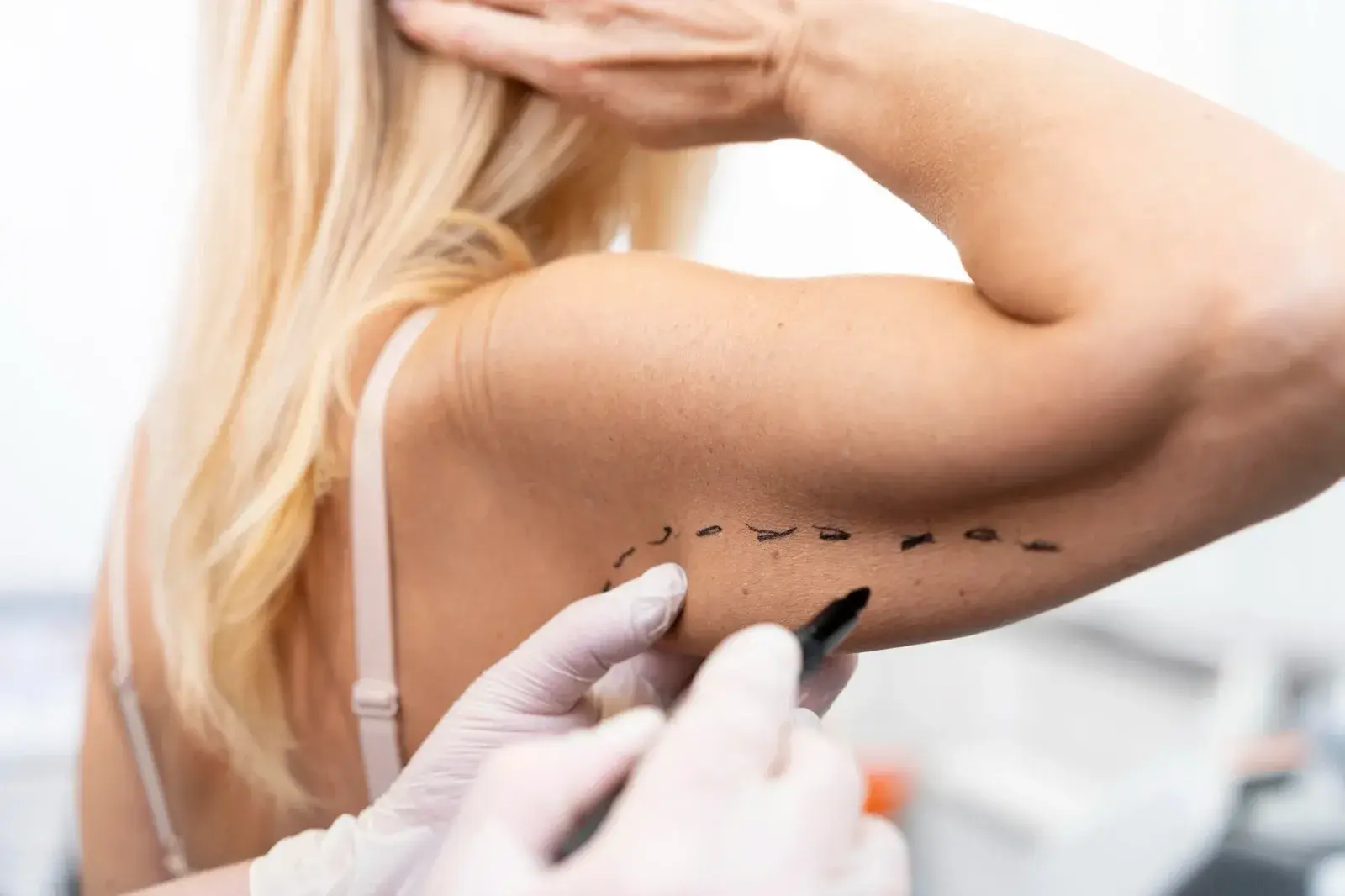 Tratamiento de Celulitis y Flacidez — Perfect by Dr. Orsini, Caracas