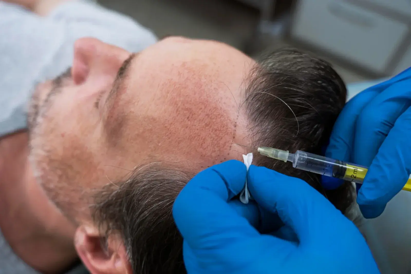 Regeneración capilar — Perfect by Dr. Orsini, Caracas
