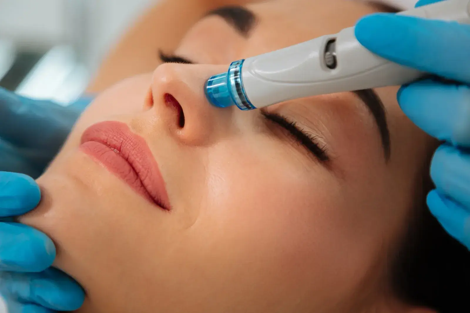 HydraFacial — Perfect by Dr. Orsini, Caracas