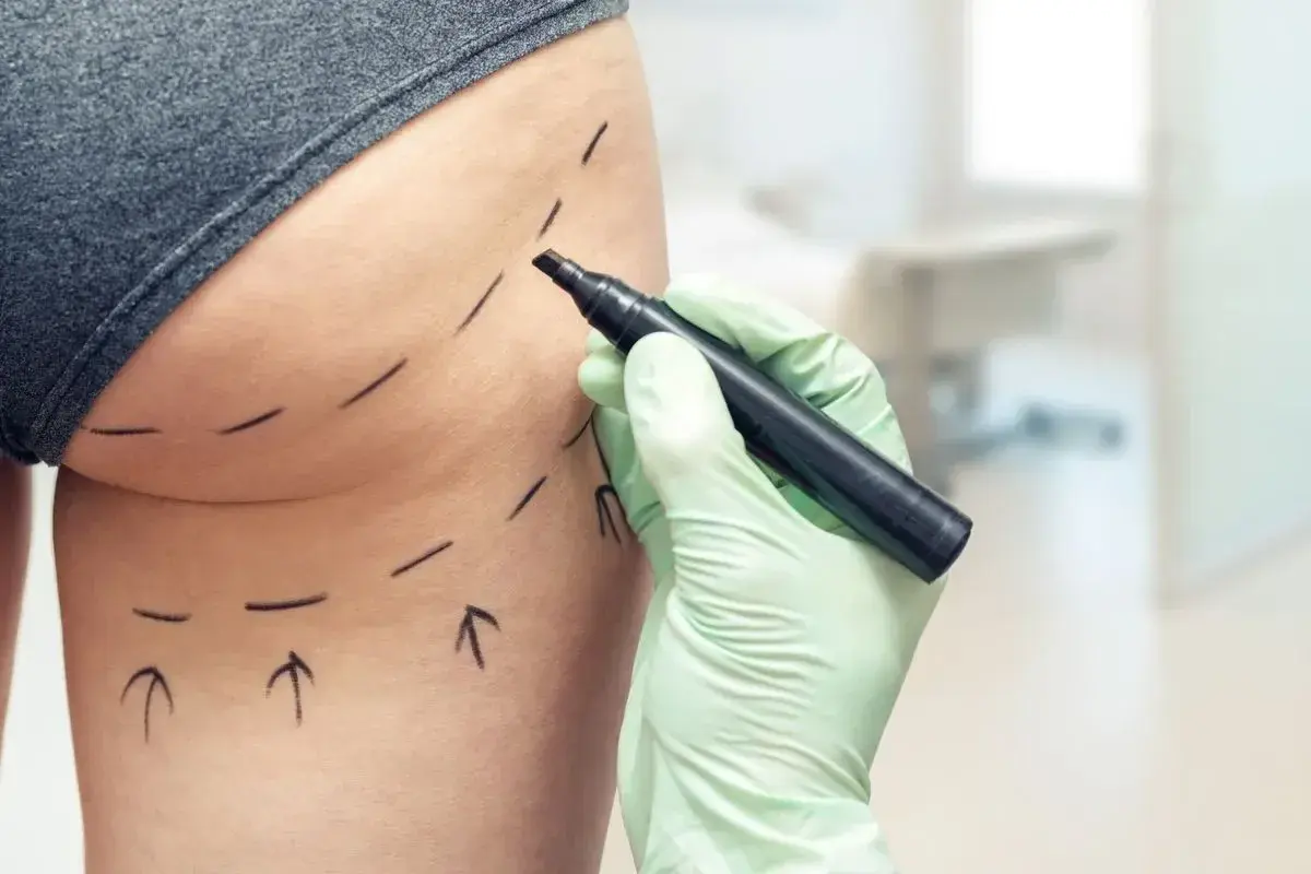 Contorno y aumento de glúteos — Perfect by Dr. Orsini, Caracas