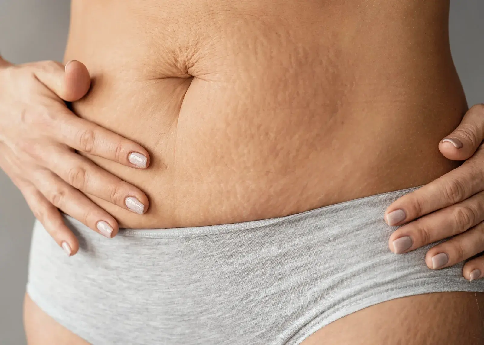 Tratamiento de estrías y cicatrices — Perfect by Dr. Orsini, Caracas