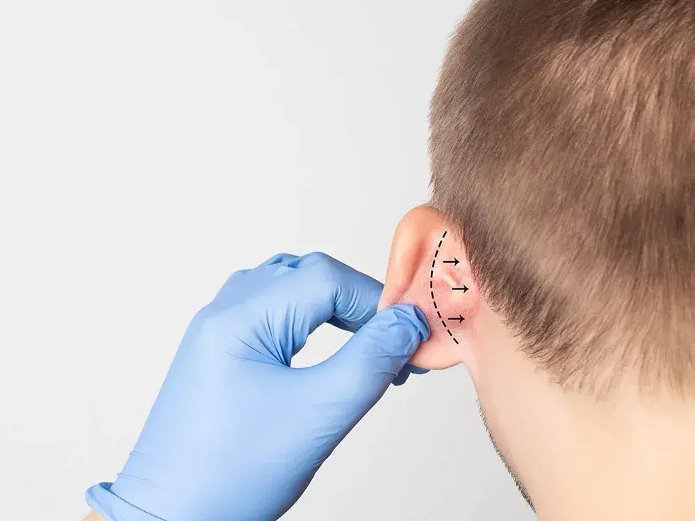 Otoplastia — Perfect by Dr. Orsini, Caracas