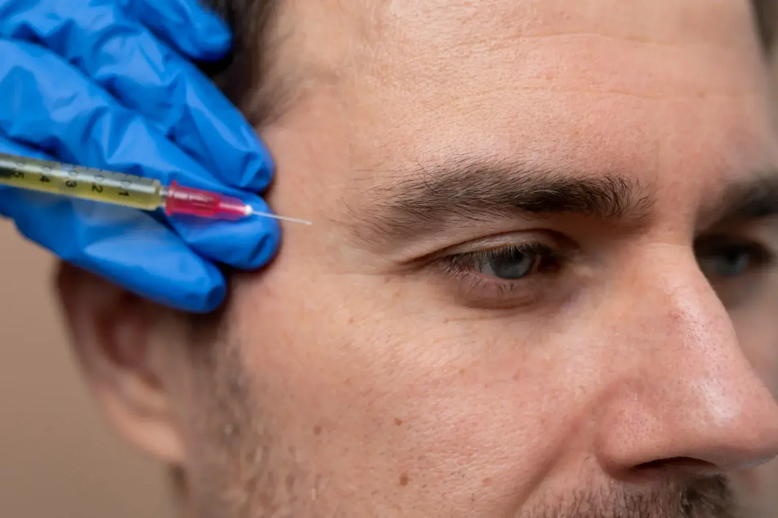 Plasma Rico en Plaquetas (PRP) — Perfect by Dr. Orsini, Caracas