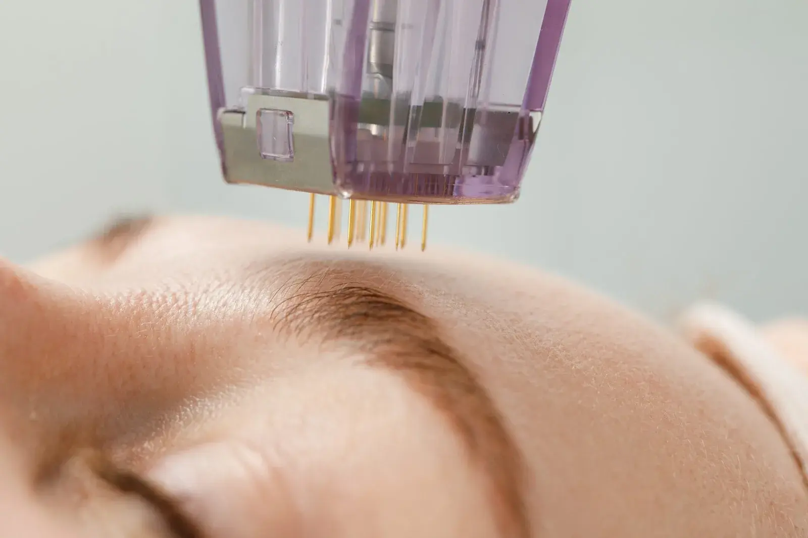 Morpheus8: radiofrecuencia con microagujas — Perfect by Dr. Orsini, Caracas